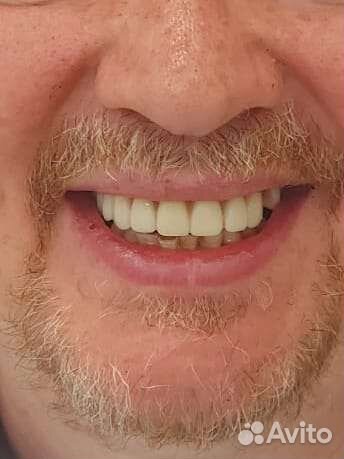 Съёмные/зубные протезы,коронки на зуб