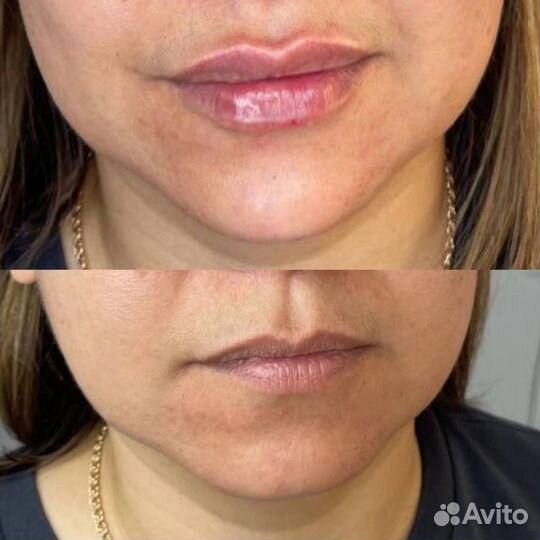 Модель на увеличение губ