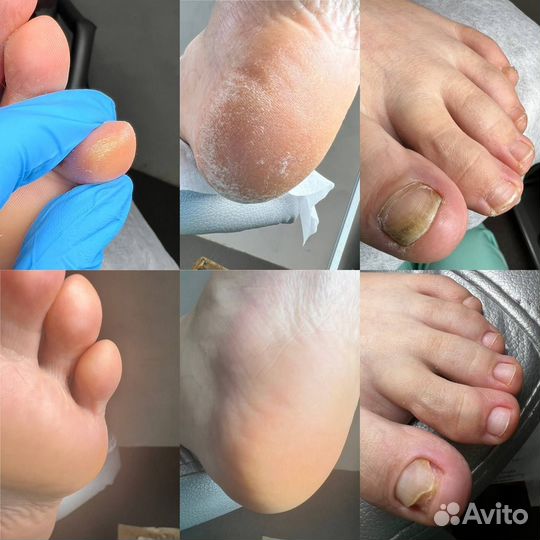 Подолог с выездом на дом