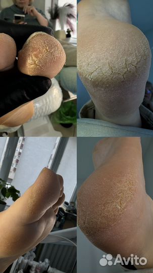 Смарт педикюр обучение