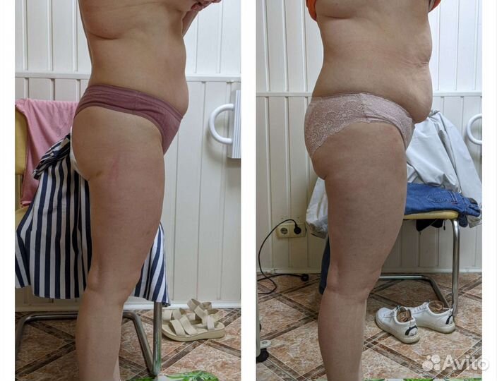 Массаж. Антицеллюлитный массаж