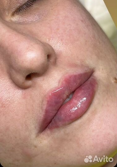 Биоревитализация