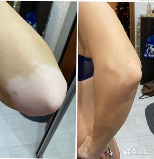 Лосьон - автозагар маскирует витилиго