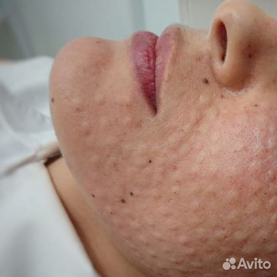 Коктейль монако мезотерапия биоревит липолитики