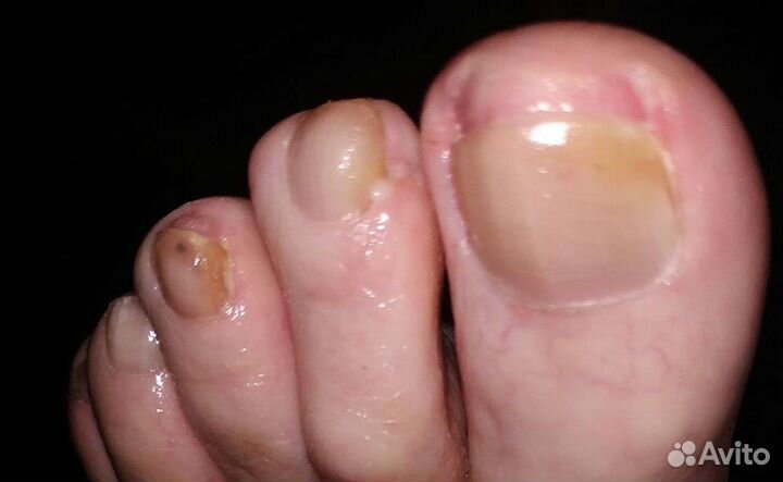 Лечебный педикюр