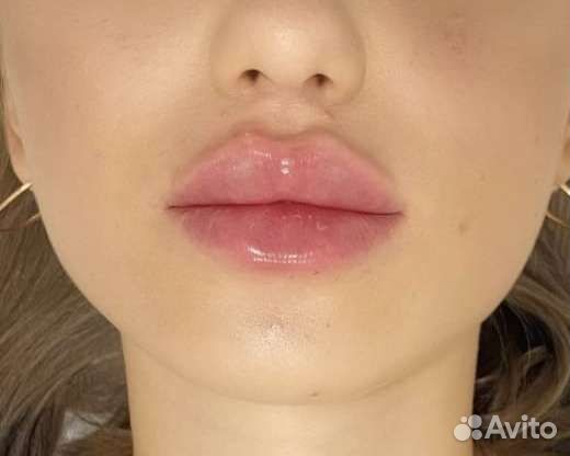 Увеличение губ