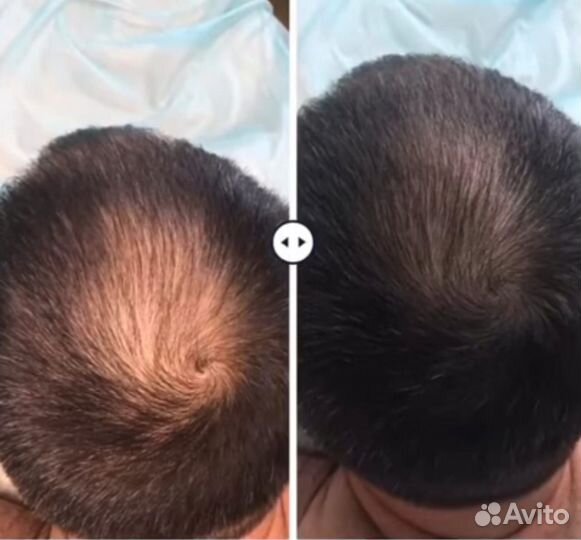 Услуги косметолога / Холодная плазма