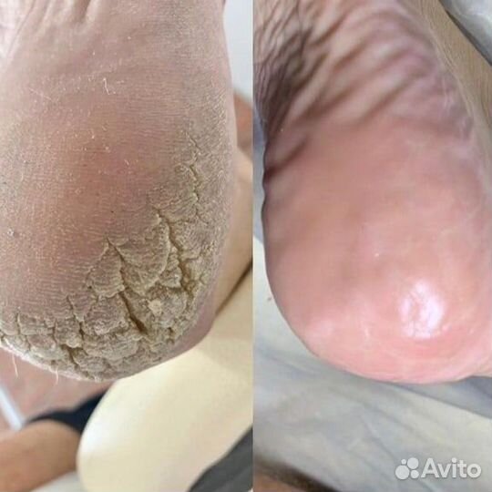 Услуги подолога/ выезд на дом