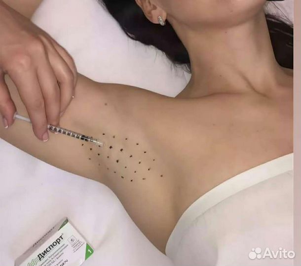 Устранение потливости. Гипергидроз