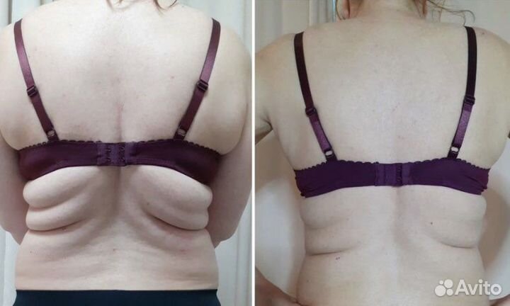 Похудение криолиполиз кавитация RF