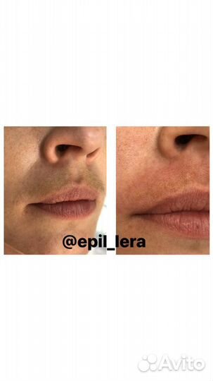 Электроэпиляция: подмышки