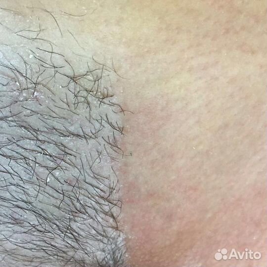 Шугаринг Воск Ваксинг Электро Депиляция Эпиляция