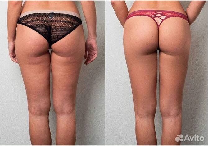 Коррекция фигуры