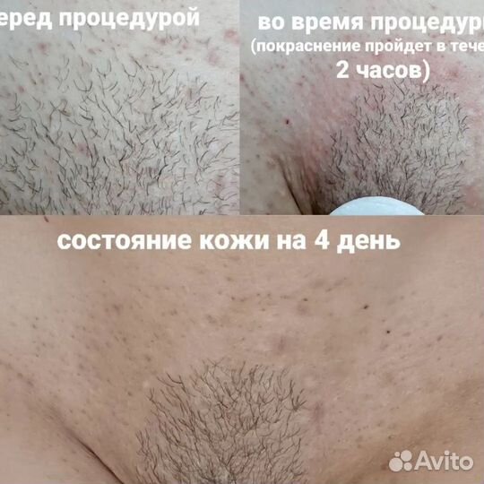 Электроэпиляция