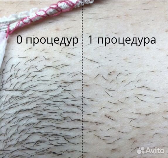 Электроэпиляция