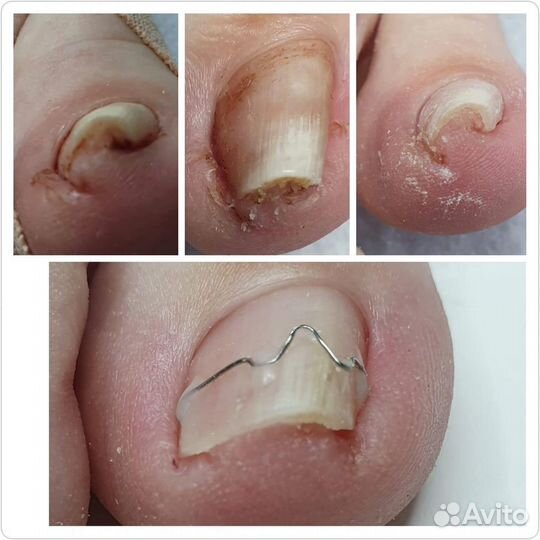 Подолог с выездом на дом