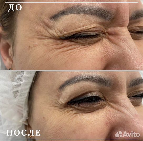 Ботулинотерапия