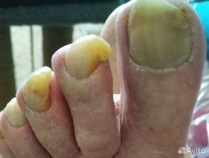 Лечебный педикюр