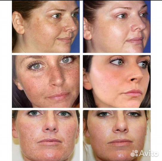 Отбеливающий крем