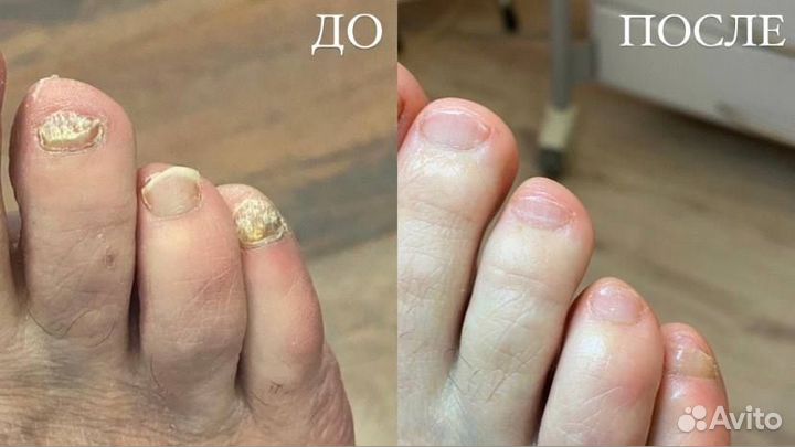 Врач подолог, медицинский педикюр