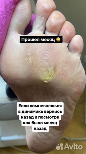 Подологический педикюр