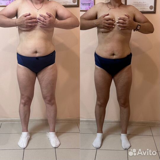 Эндо - Сфера, LPG массаж,вакуумный,корекция фигуры