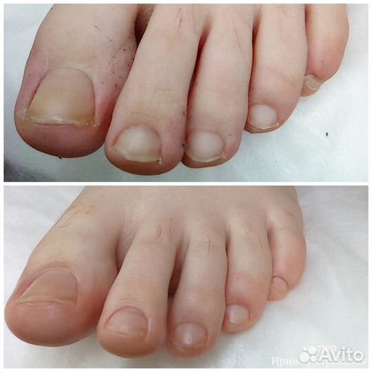 Педикюр. Подология