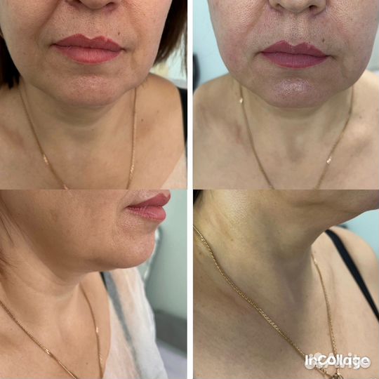 Аппаратный массаж лица