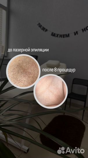 Лазерная эпиляция