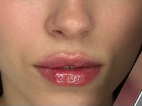 Контурная пластика губ. Опытный косметолог