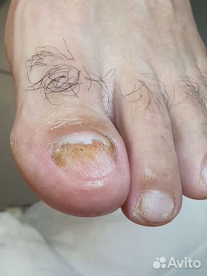 Подолог,медицинский педикюр, маникюр, SMART