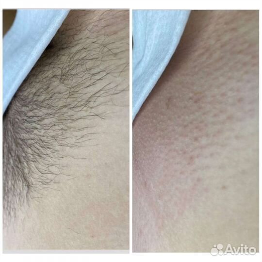 SPA -Шугаринг