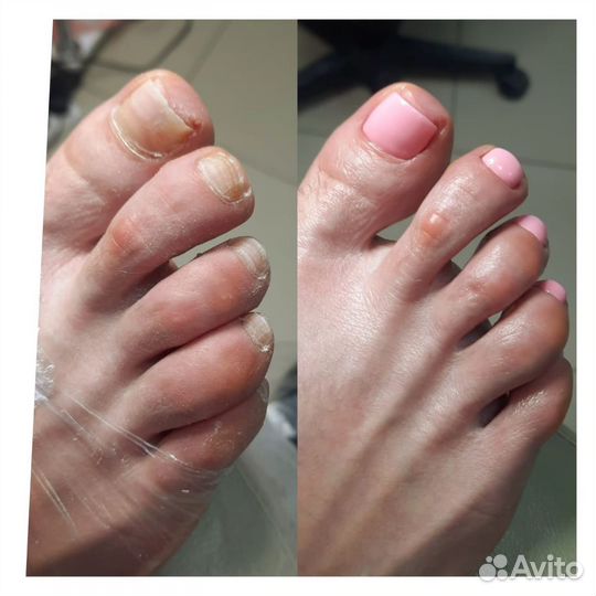 Титановая нить педикюр