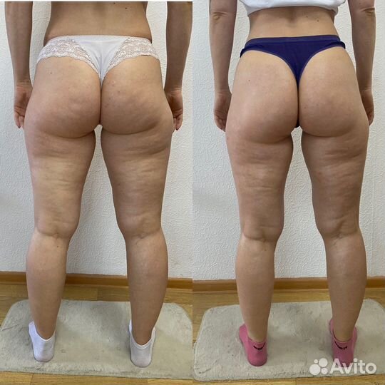 Антицеллюлитный массаж