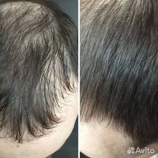 Восстановление и увеличение роста волос