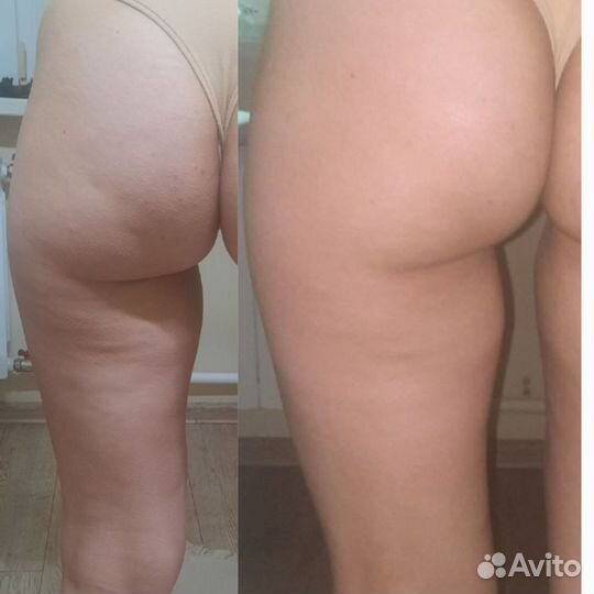 Аппарат Индиба (indiba) Похудение, омоложение