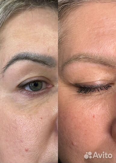 Удаление татуажа лазером