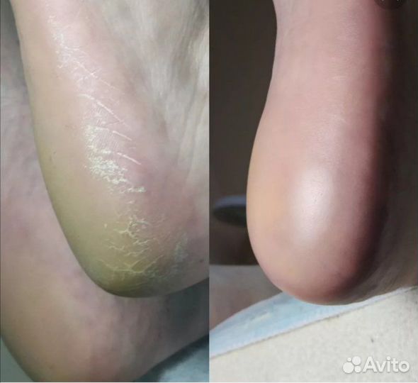 Нужны модели на педикюр