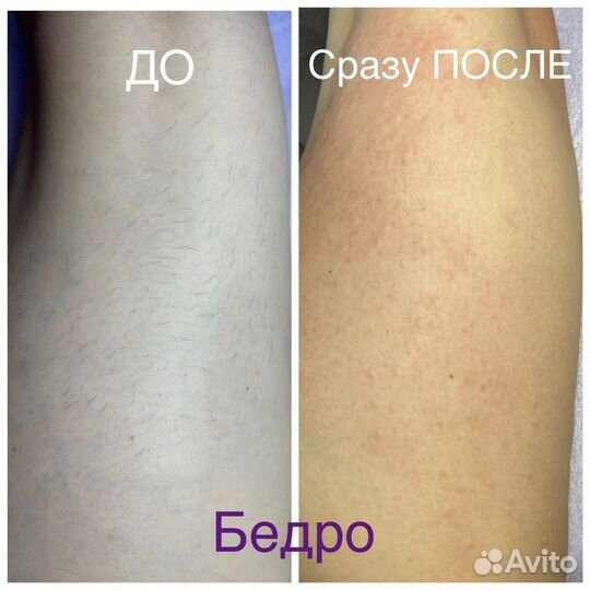 Электроэпиляция