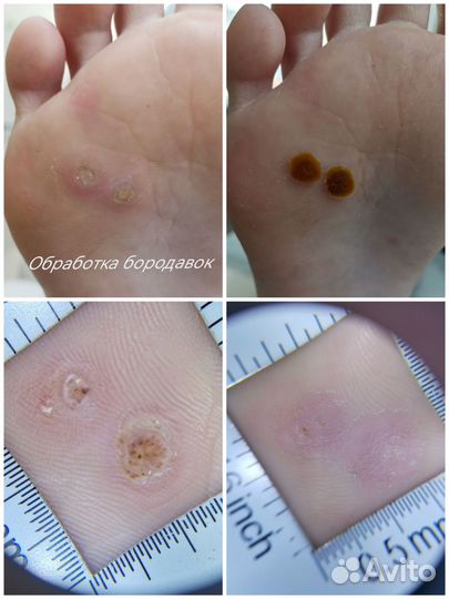 Подолог. Педикюр(грибок,вросший ноготь и др)