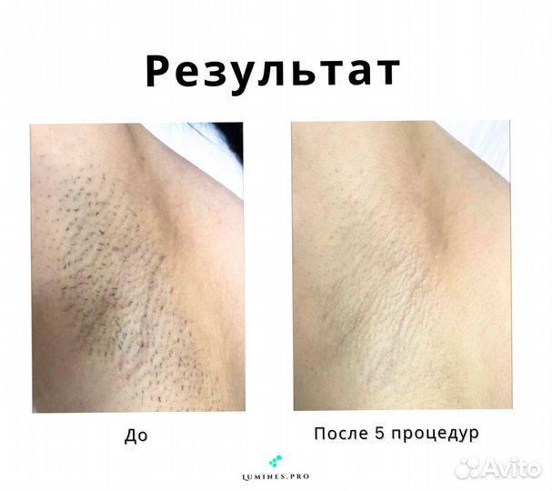 Диодный лазер для эпиляции Lumines Max’One 1200вт