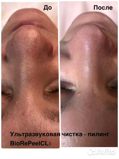 Комбинированная чистка лица