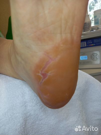 Медицинский педикюр