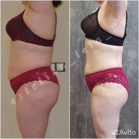 LPG массаж, аппаратная коррекция фигуры