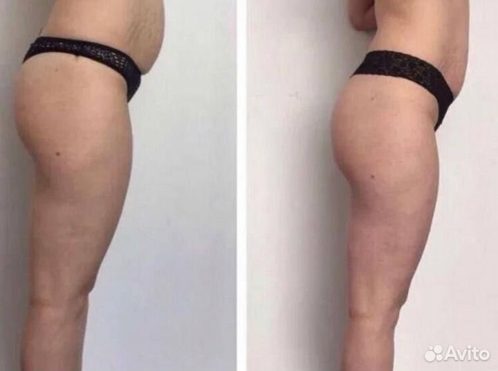 LPG массаж vela Shape