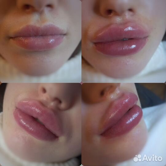 Увеличение губ