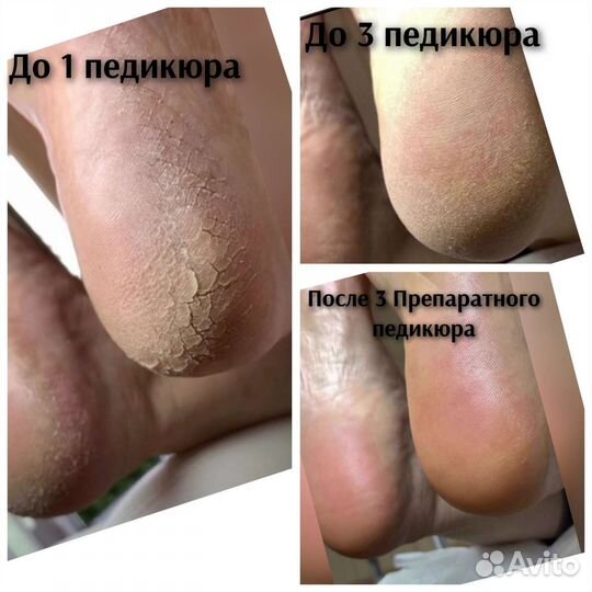 Препаратный педикюр. Наращивание ногтей, гель-лак