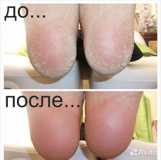 Педикюр в технике SMART