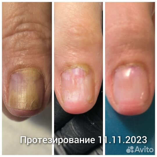 Медицинский педикюр, подолог