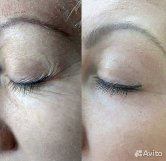 Дарсонвализация